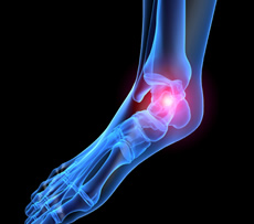Ankle & Heel Pain - Plantar Fasciitis - treatment