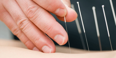 Dry Needling