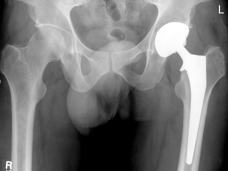 Do I need a hip replacement