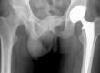 Do I need a hip replacement